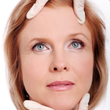 Signature Plastic & Reconstructive Surgery - face - Face lift - female