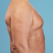 Signature Plastic & Reconstructive Surgery - male procedures - male breast reduction