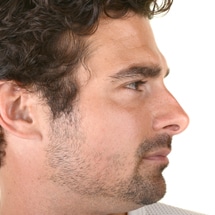 Signature Plastic & Reconstructive Surgery - male procedures - nose reshaping