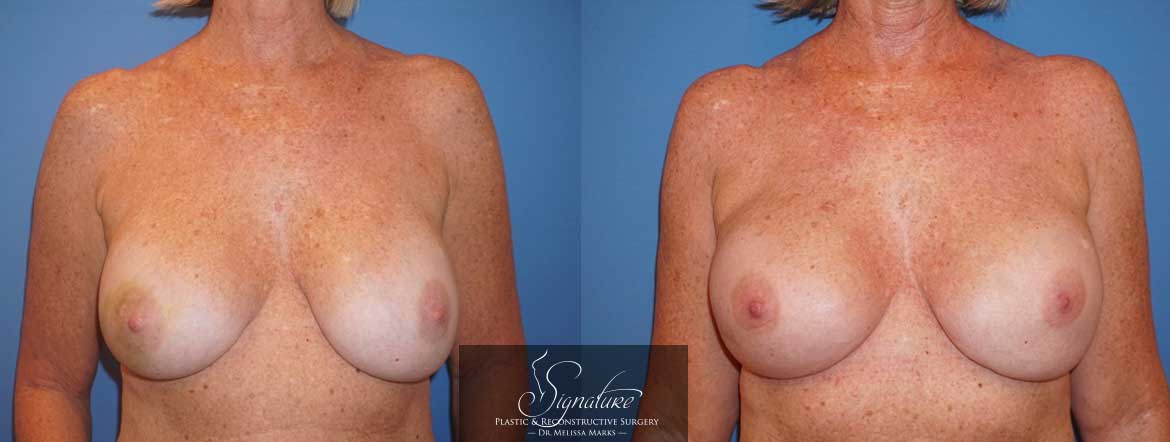 Signature Plastic & Reconstructive Surgery - Breast Reconstruction for Cancer