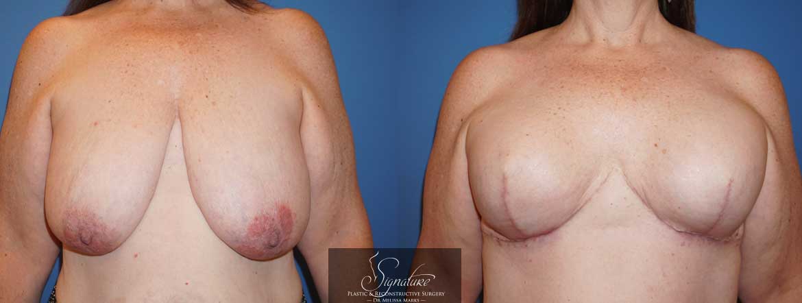 Signature Plastic & Reconstructive Surgery - Breast Reconstruction for Cancer - Bilateral Mastectomy