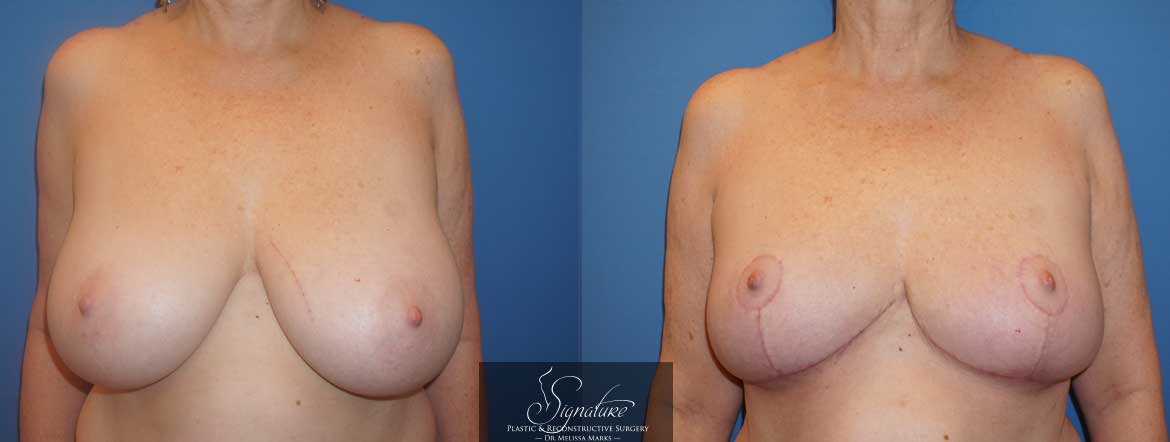 Signature Plastic & Reconstructive Surgery - Bilateral Breast Reduction