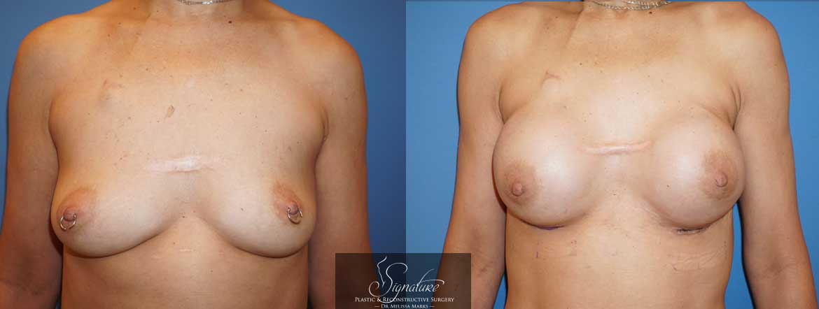 Signature Plastic & Reconstructive Surgery - Bilateral Breast Reconstruction for Cancer