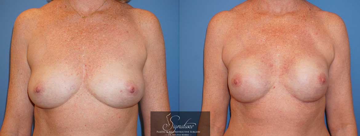 Signature Plastic & Reconstructive Surgery - Bilateral Breast Reconstruction for Cancer - Bilateral mastectomy