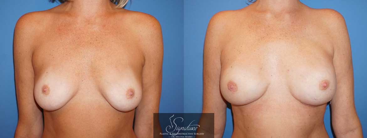 Breast reconstruction for cancer - BRCA Gene Breast Cancer