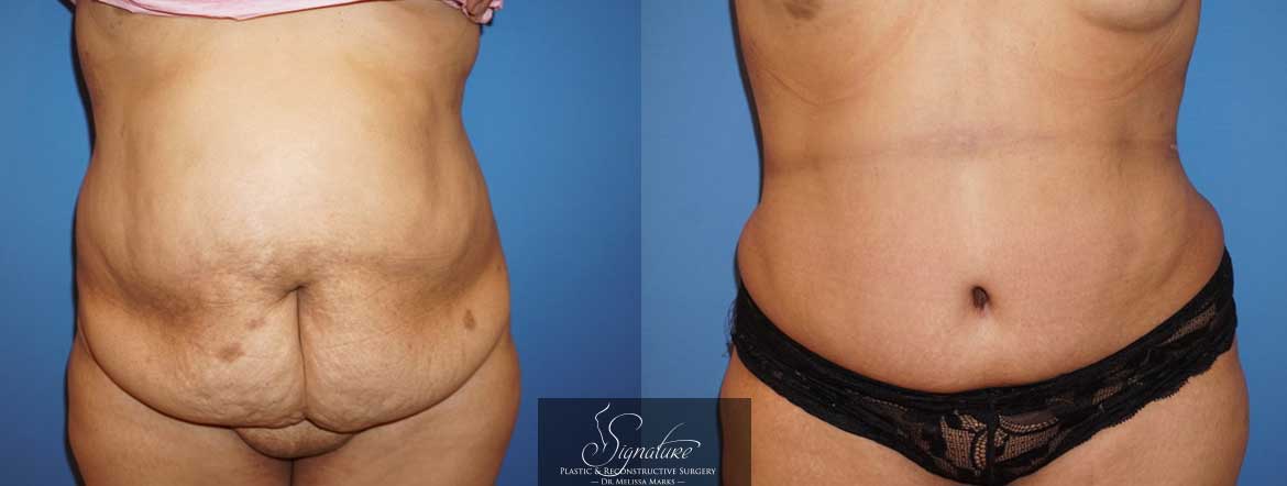 Signature Plastic & Reconstructive Surgery - Bilateral Breast Reconstruction for Cancer - Tummy Tuck