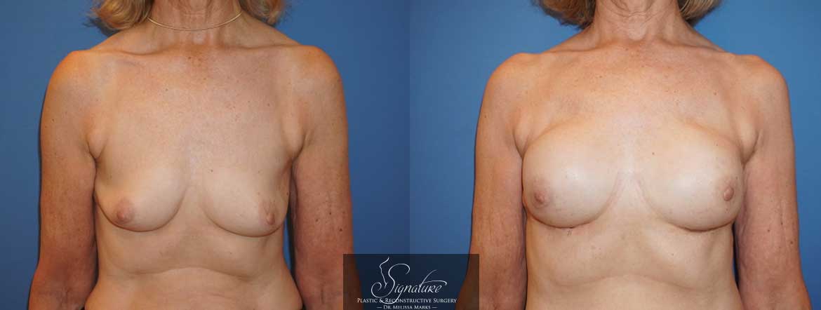 Signature Plastic & Reconstructive Surgery - Breast reconstruction for cancer