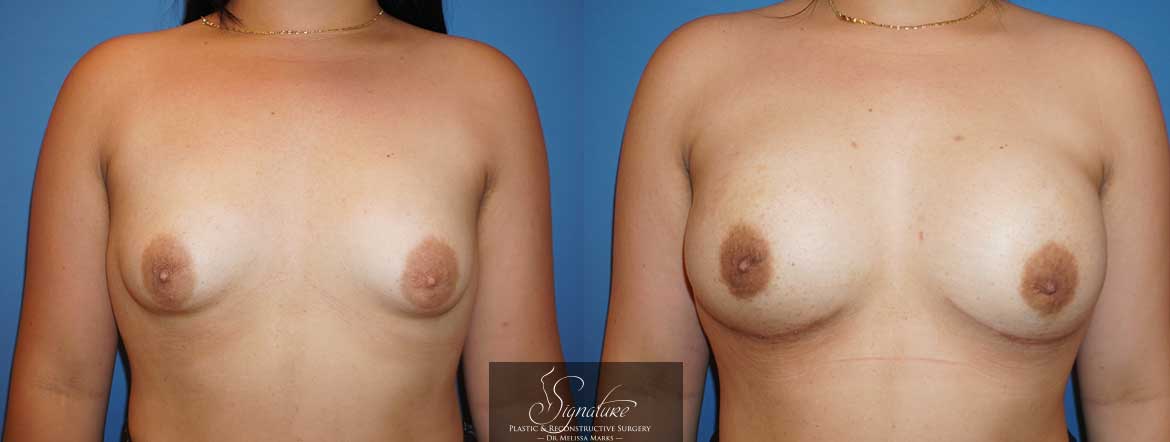breast reconstruction for cancer