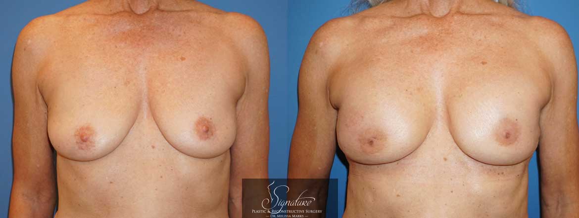 Breast Reconstruction for Cancer - Dr. Melissa Marks Palm Beach Gardens