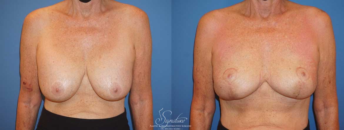 Breast Implant Removal - Mastopexy - Signature Plastic & Reconstructive Surgery