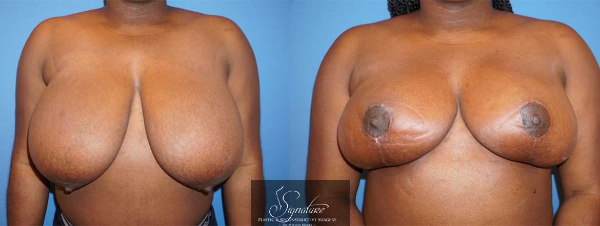 Dr. Melissa Marks - Breast Reduction