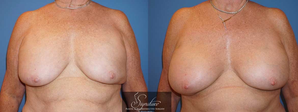 Signature Plastic & Reconstructive Surgery - Breast Implant Exchange