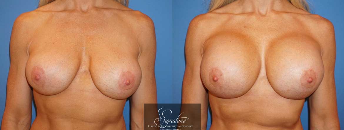 Breast Implant Exchange - Dr. Melissa Marks