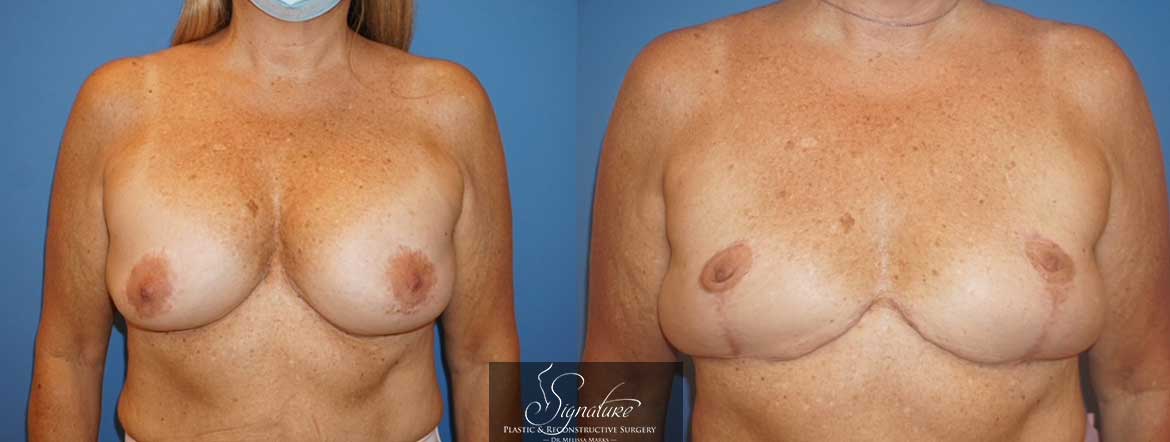Dr. Melissa Marks - Breast Implant Removal