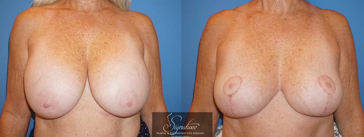 Breast Implant Removal - Dr. Melissa Marks