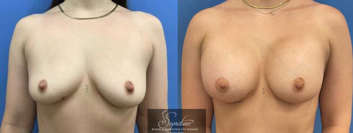 Breast Augmentation - Dr. Melissa Marks - Signature Plastic & Reconstructive Surgery