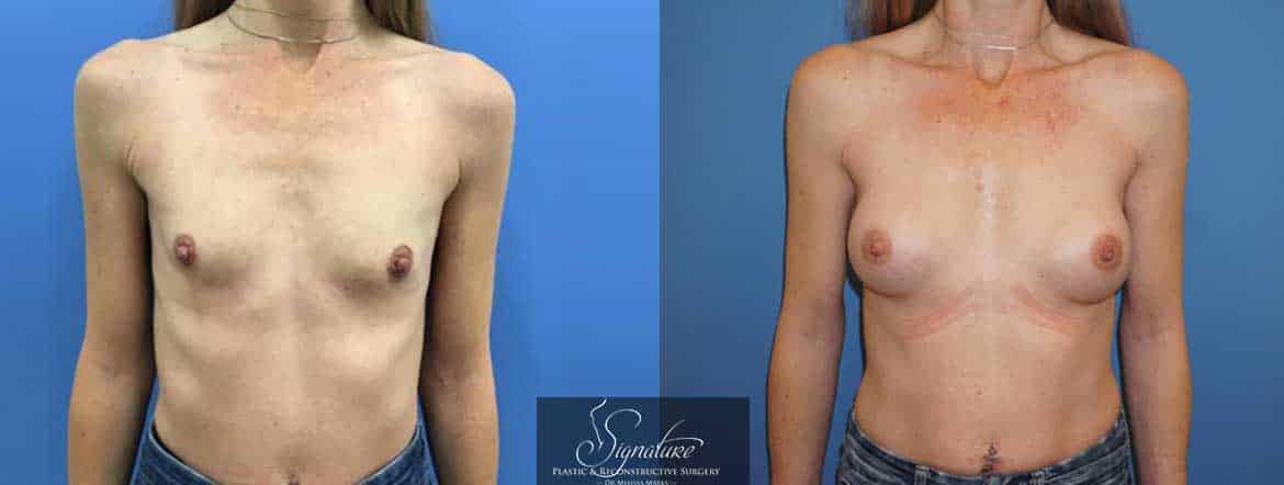 Signature Plastic & Reconstructive Surgery - Breast Augmentation