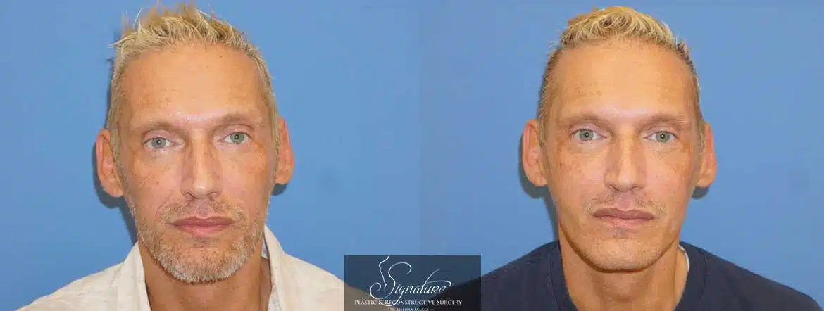 Dr. Melissa Marks - Juvederm facial filler