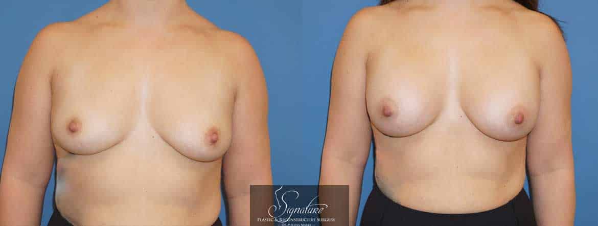 Signature Plastic & Reconstructive Surgery - Breast Augmentation