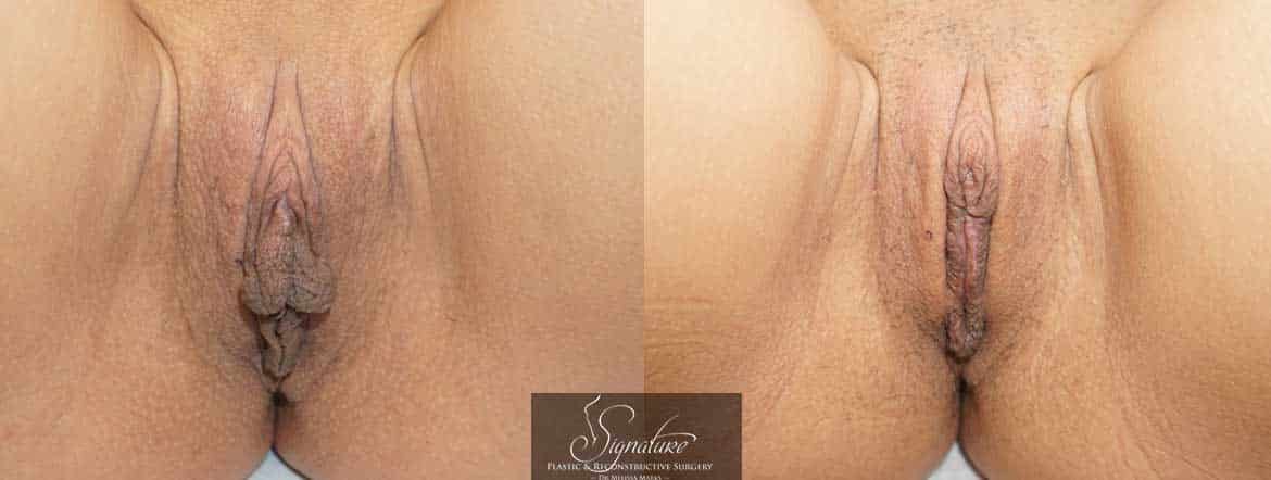 Signature Plastic & Reconstructive Surgery - Dr Melissa Marks - Female Rejuvenation