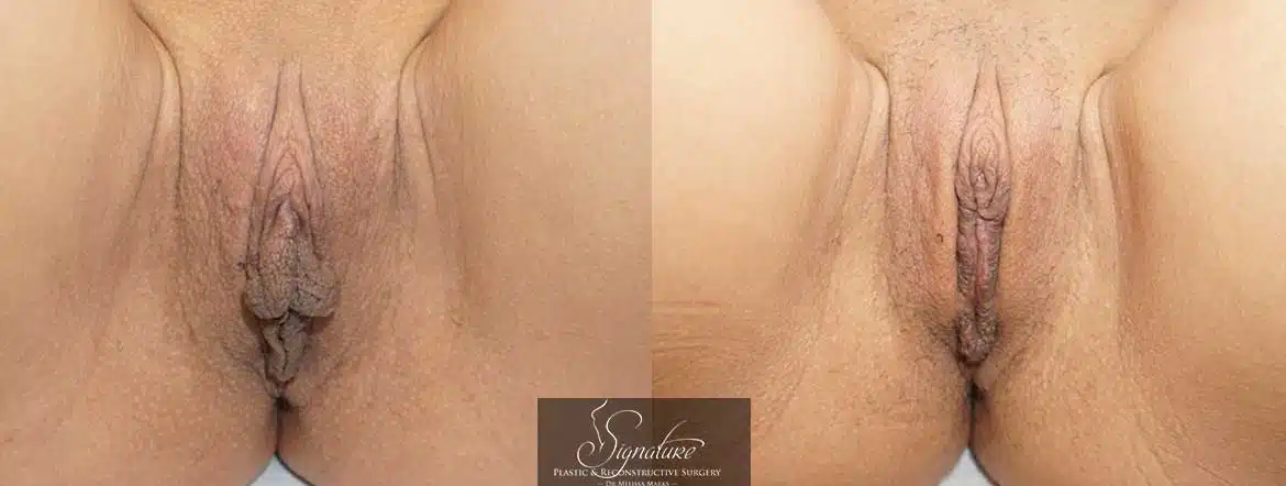 Signature Plastic & Reconstructive Surgery - Dr Melissa Marks - Female Rejuvenation