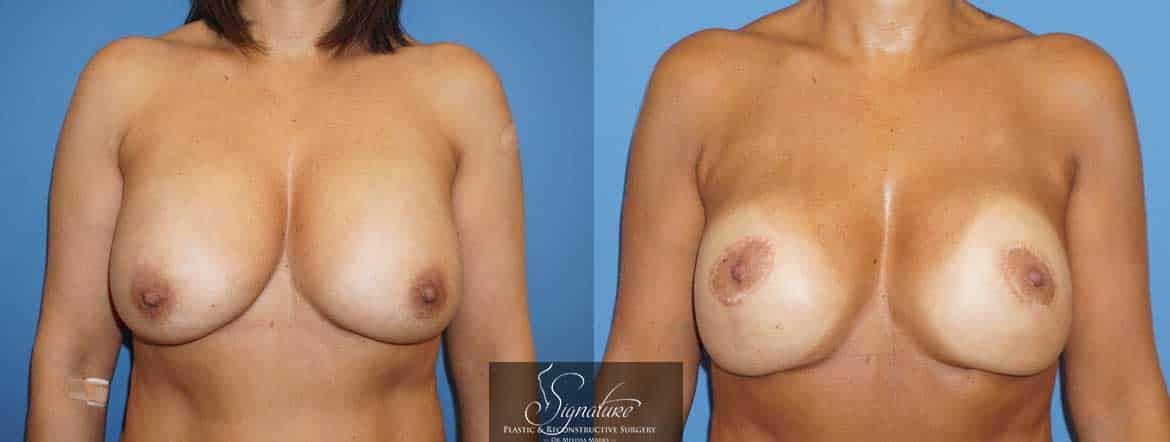 Dr. Melissa Marks - Mastopexy / Breast Lift