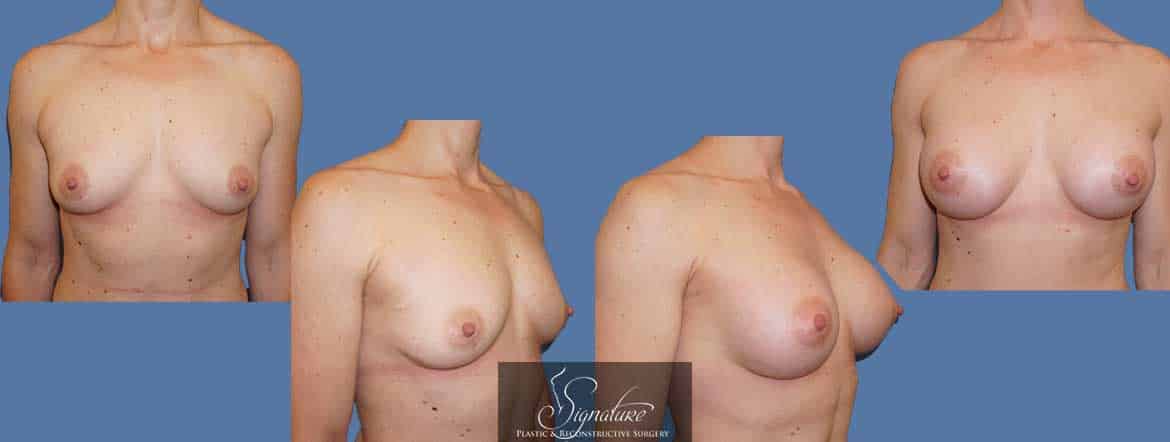 Breast Augmentation by Dr. Melissa Marks - Signature Plastic & Reconstructive Surgery