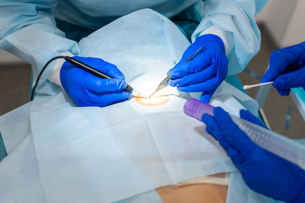 Close-up surgeon burns a mole on the back of the patient. Mole Removal Surgery Procedure.