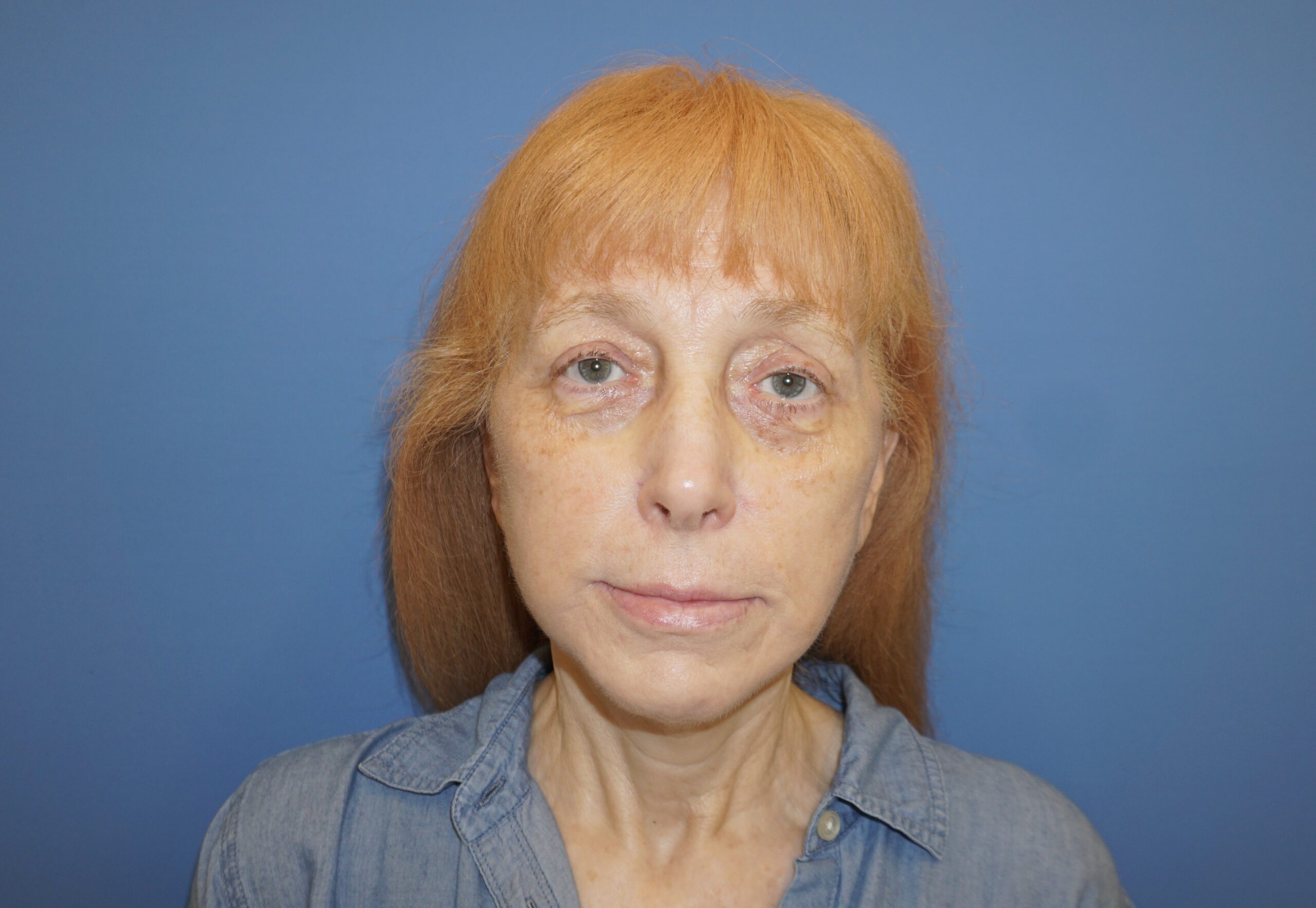 Facelift – Patient 3 After