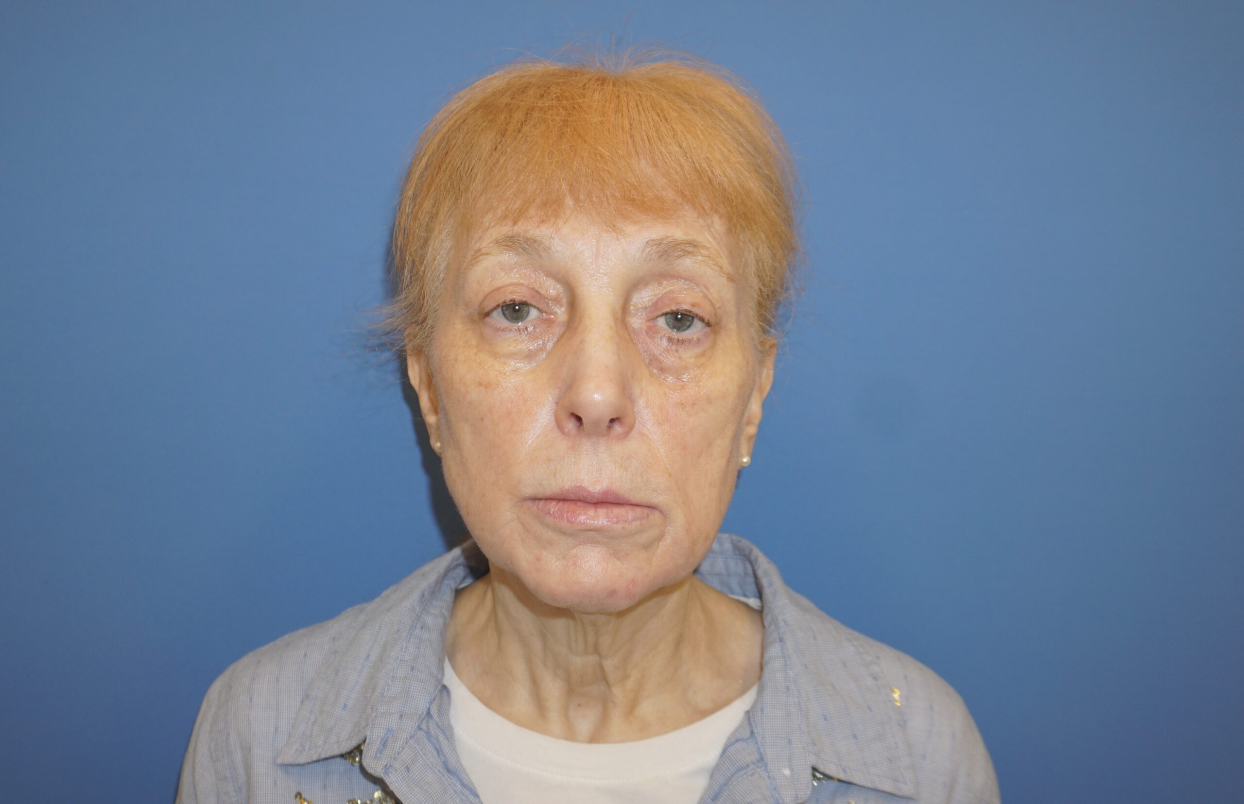 Facelift – Patient 3 After