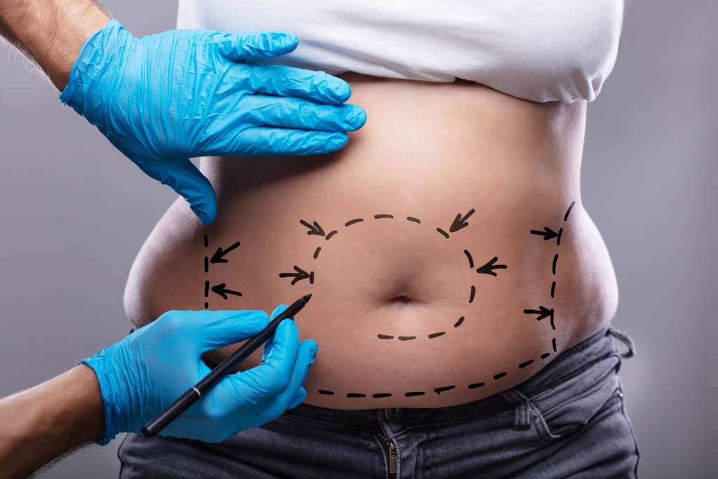 tummy tuck consultation charlotte nc