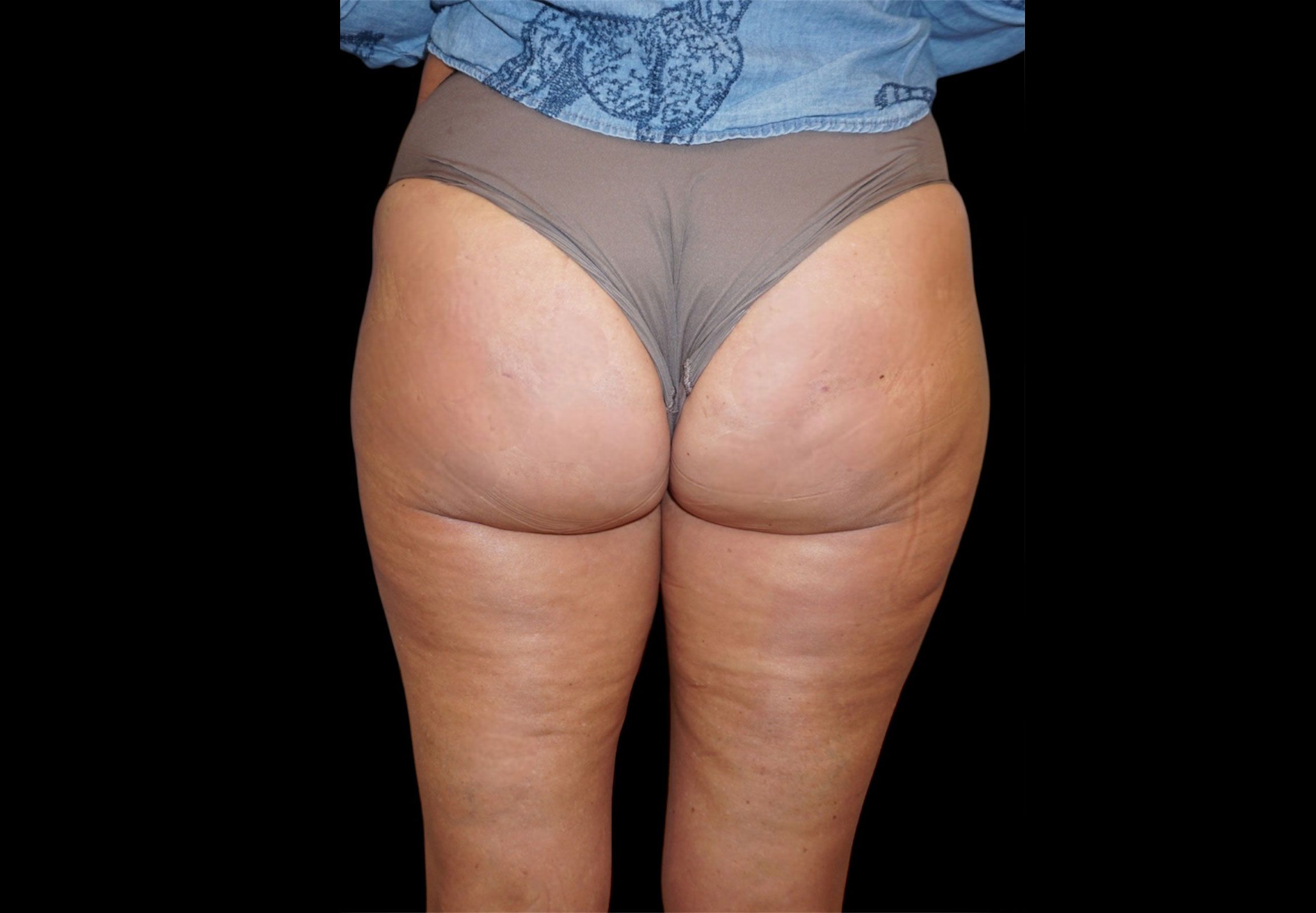 Aveli Patient 1 After