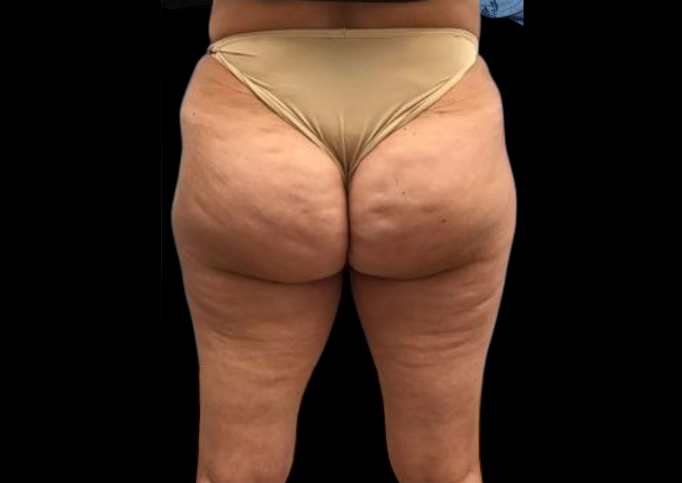 Aveli Patient 1 Before