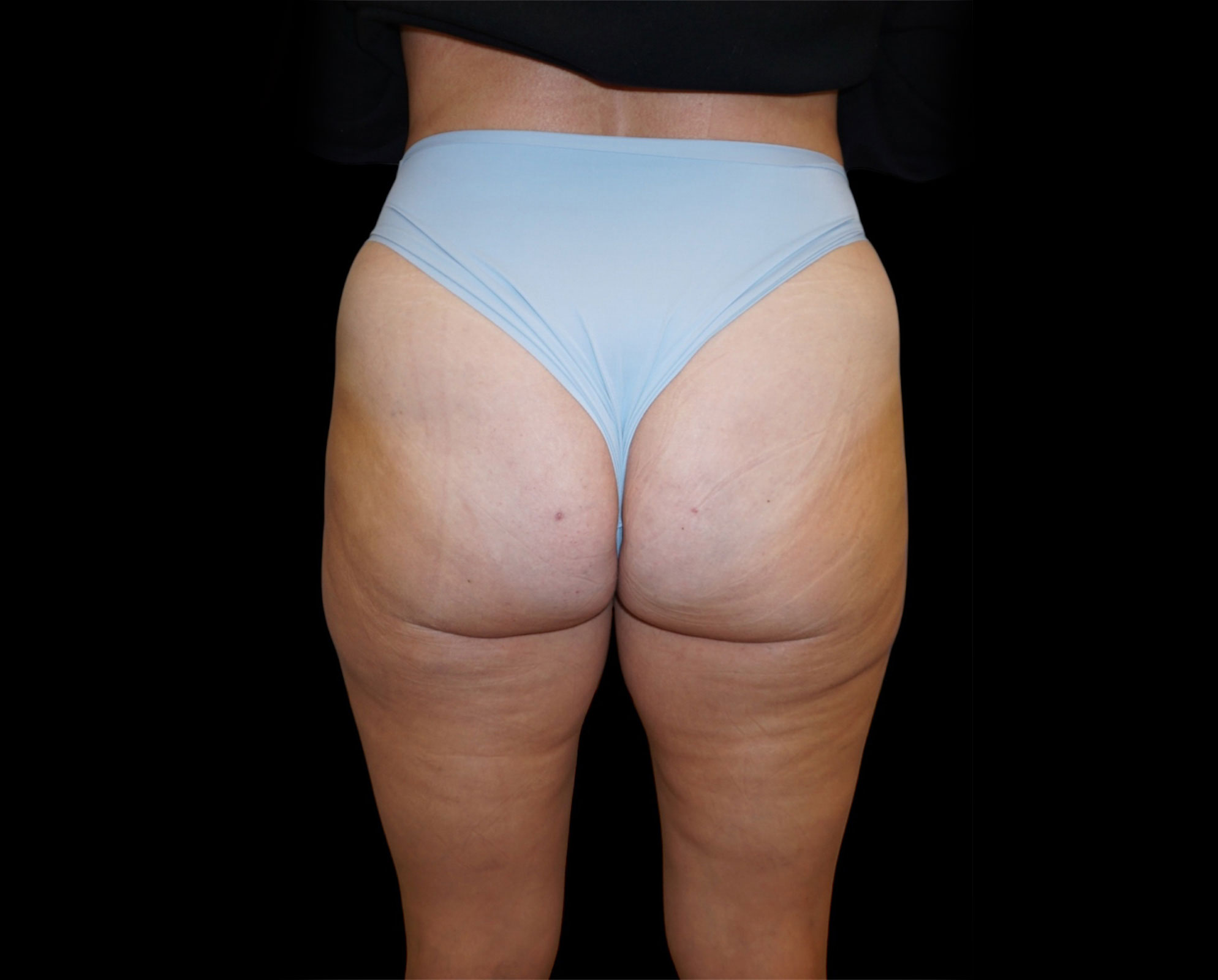Aveli Patient 2 After