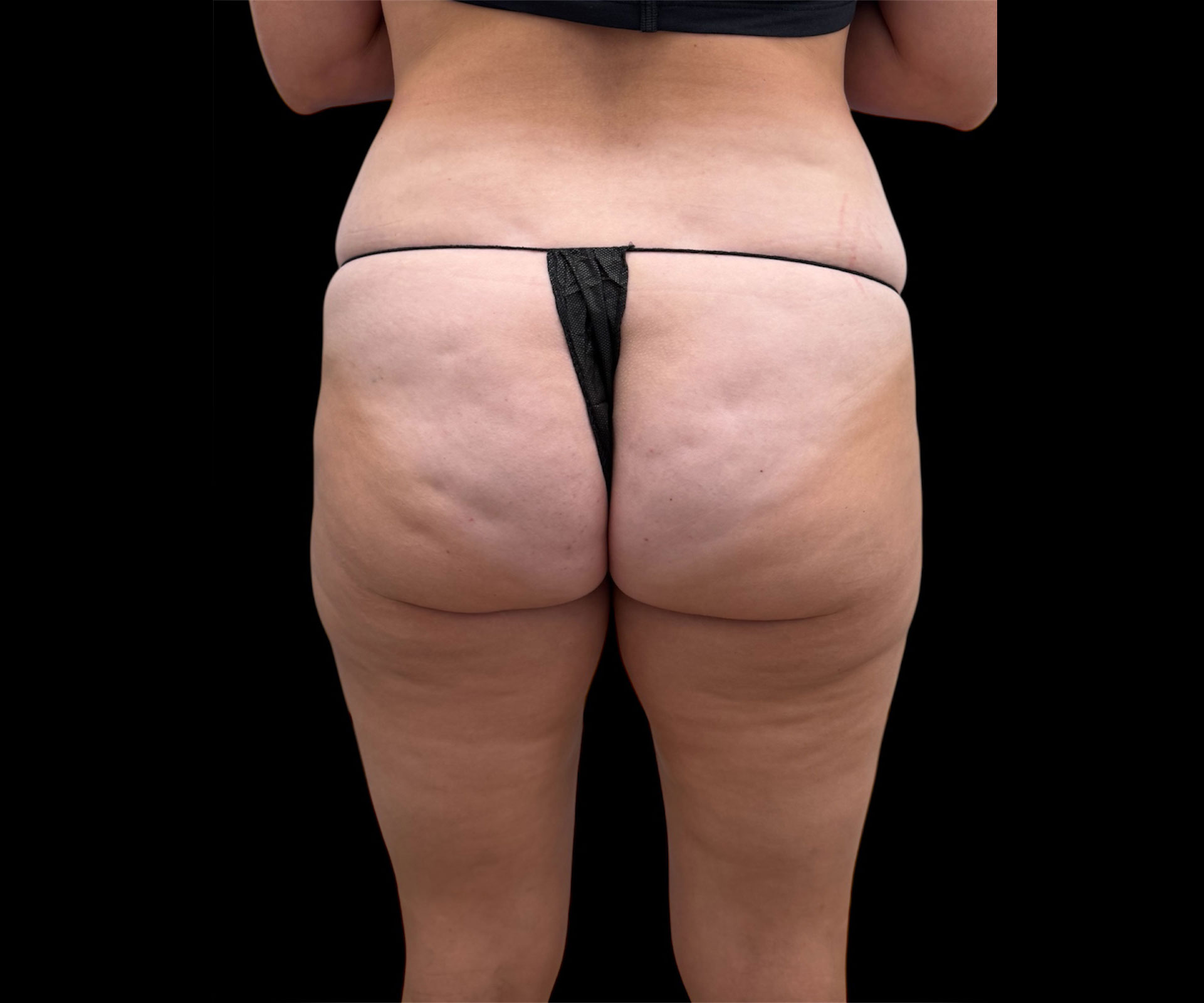 Aveli Patient 2 Before