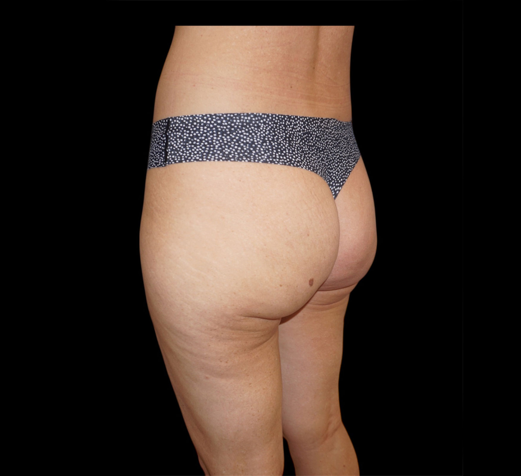 Aveli Patient 3 After