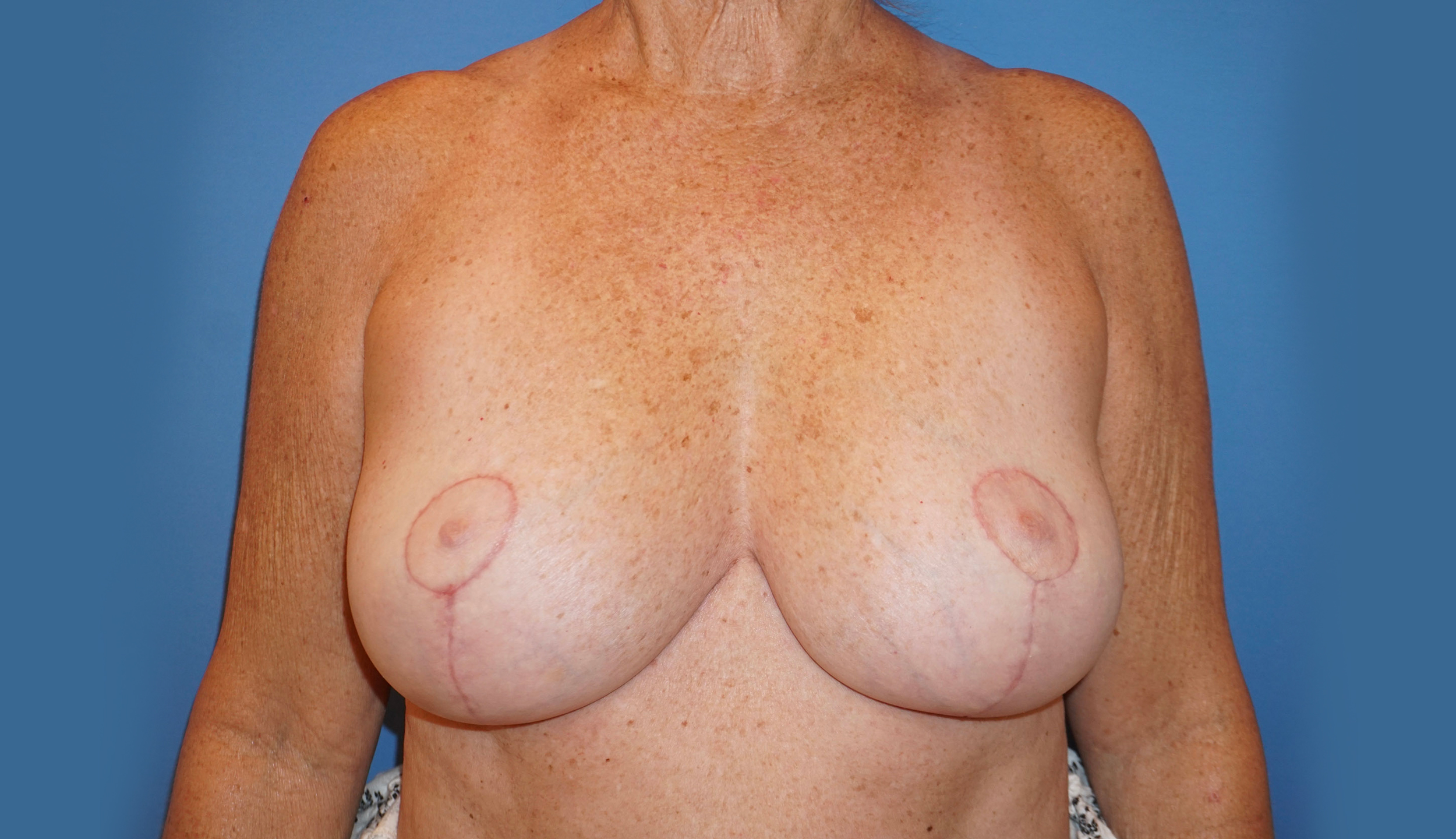 Breast Implant Removal – Patient 1 After