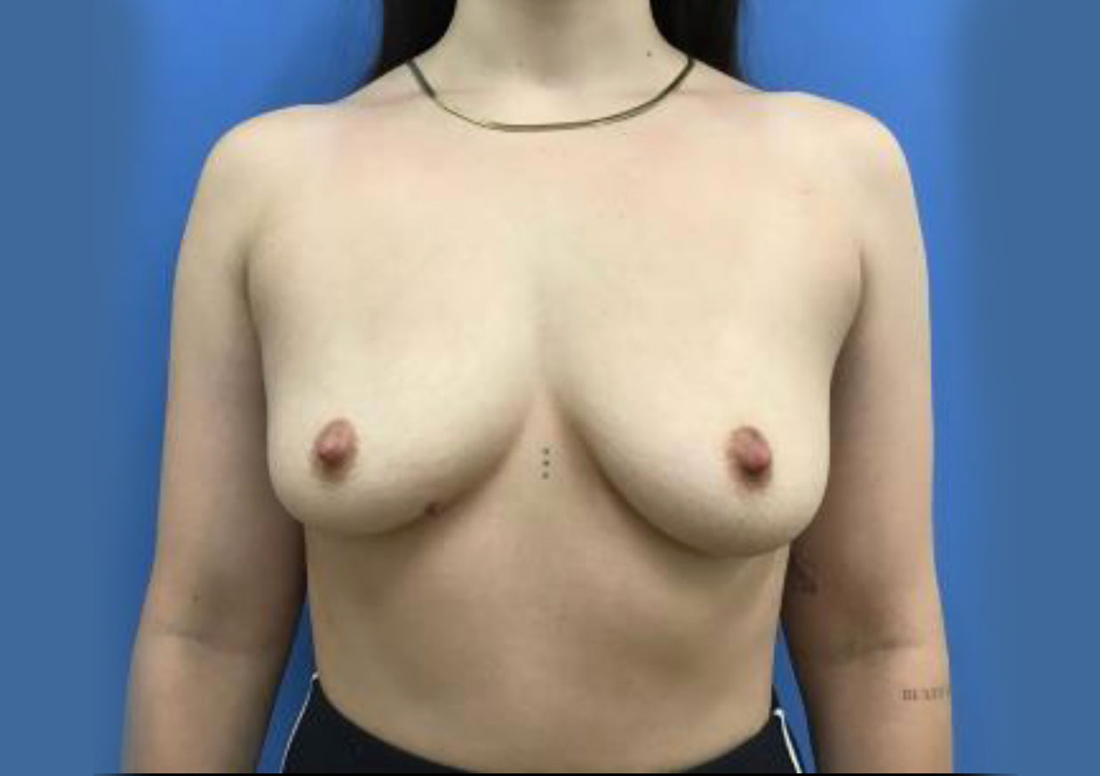 Breast Augmentation – Patient 1 Before