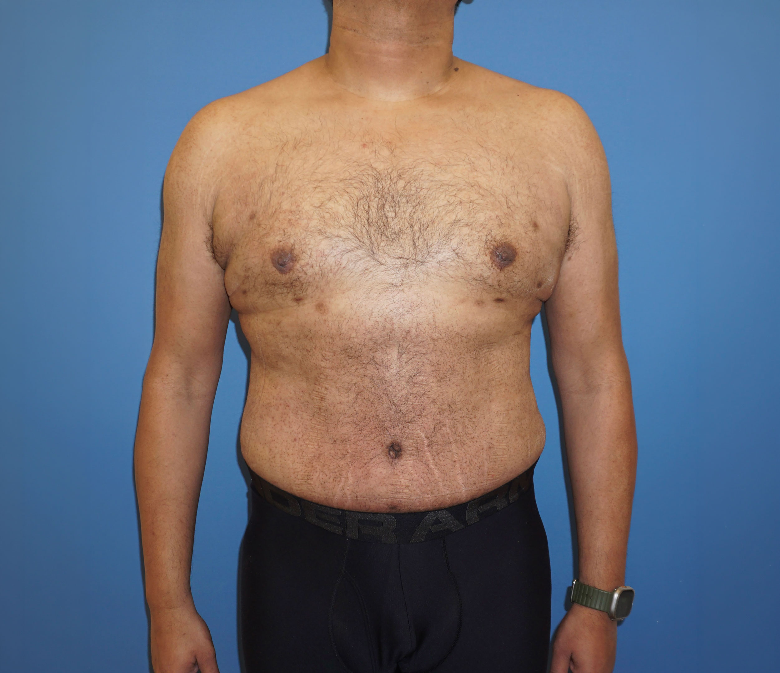 Tummy Tuck – Patient 10 After