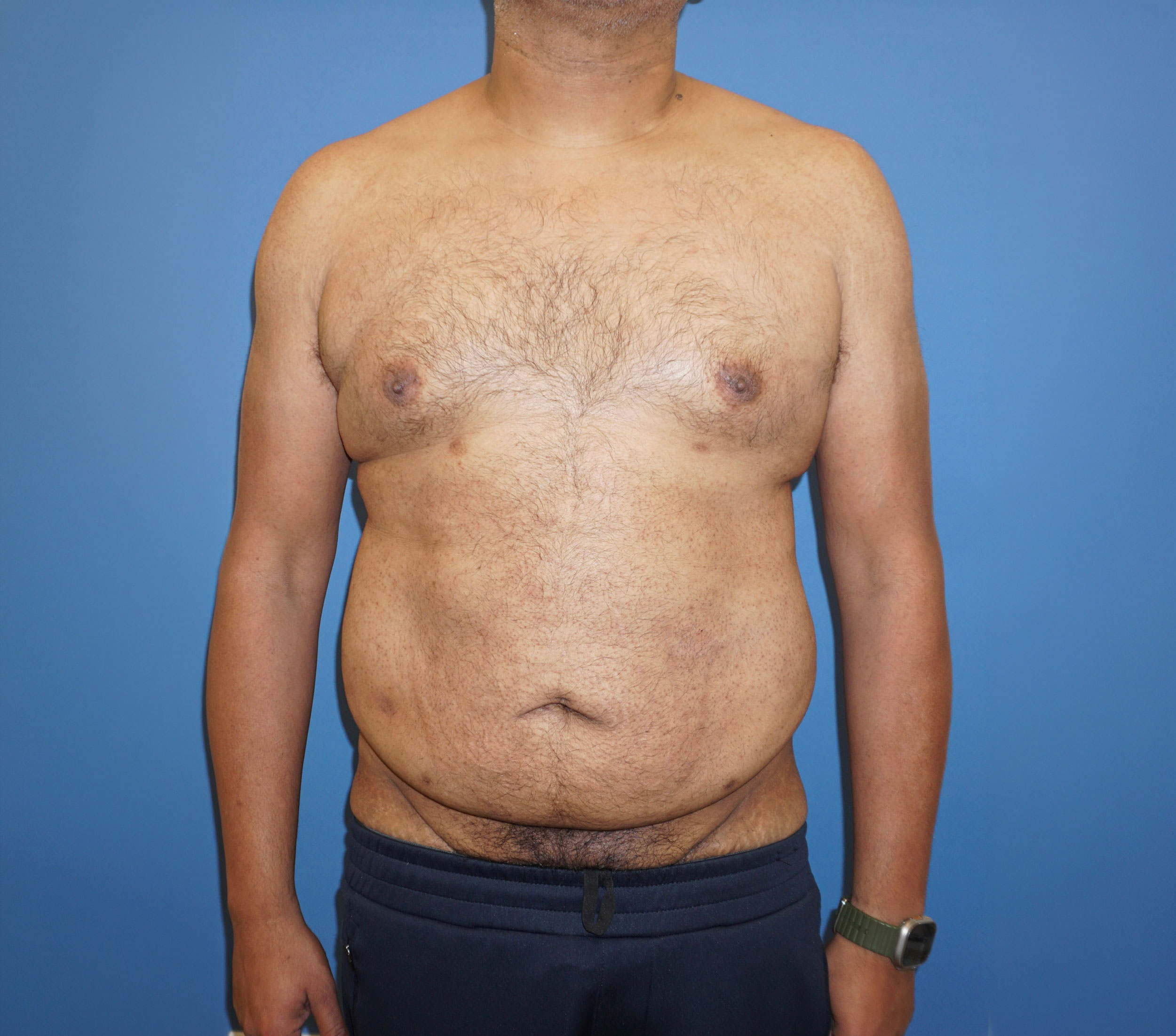Tummy Tuck – Patient 10 Before