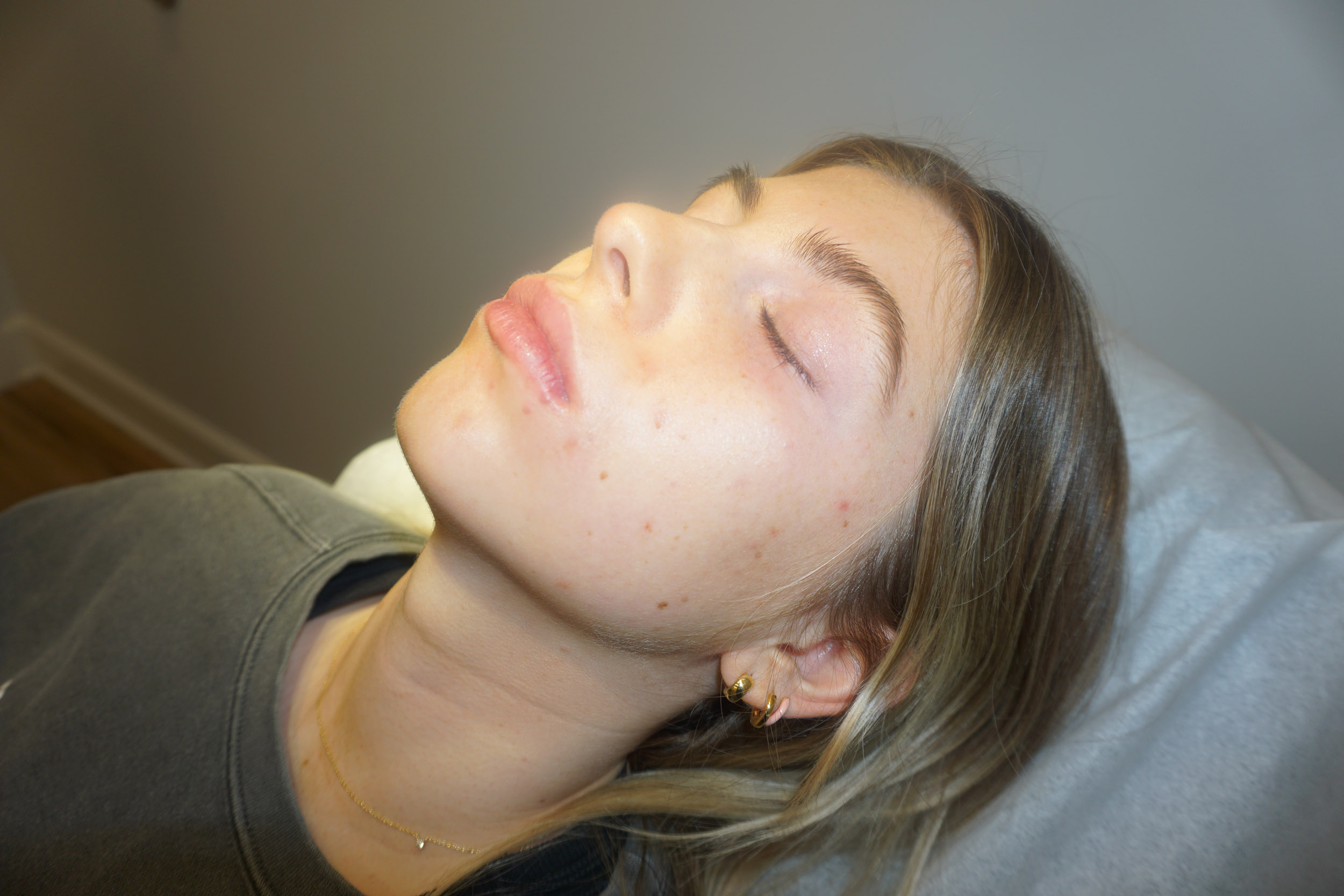 Botox – Patient 11 Before