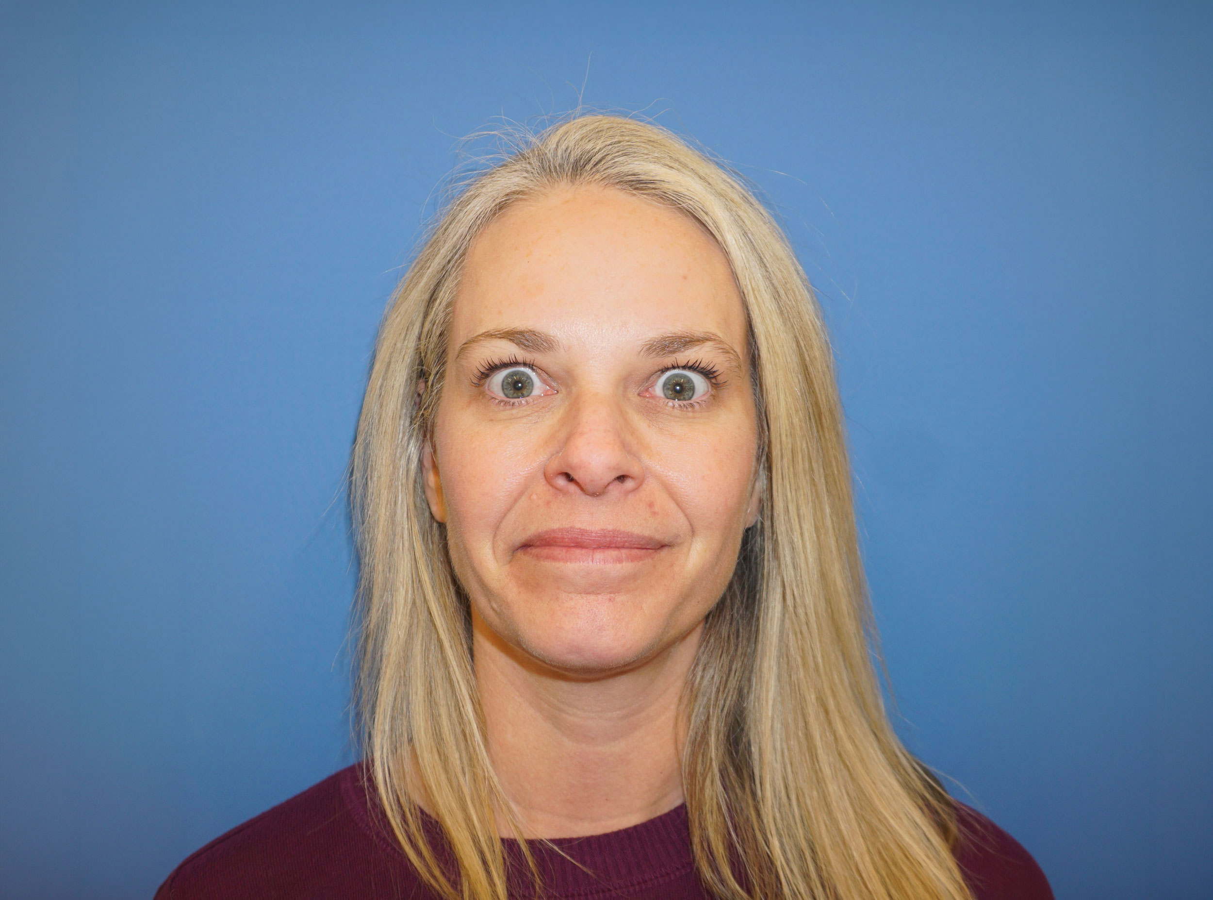 Botox – Patient 13 After