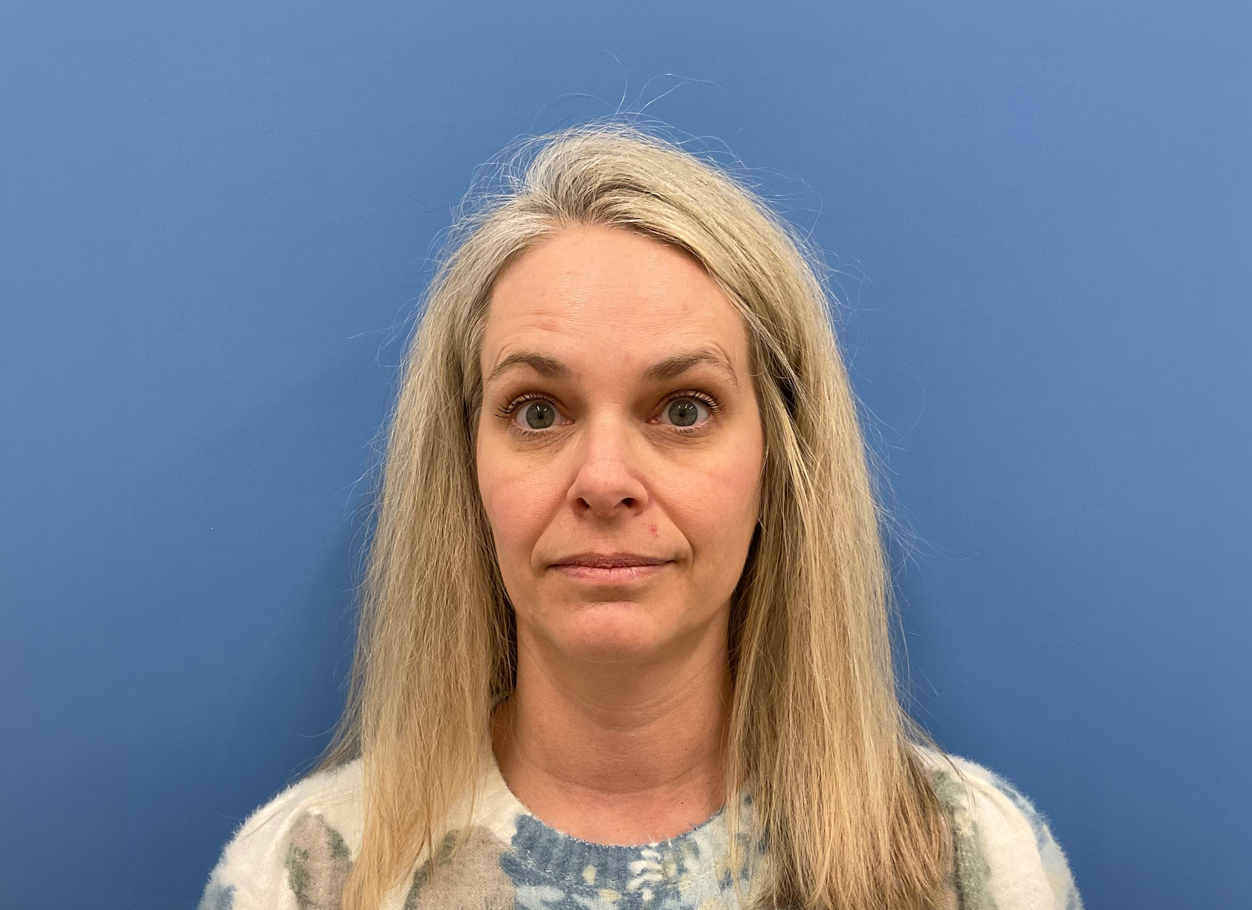 Botox – Patient 13 Before