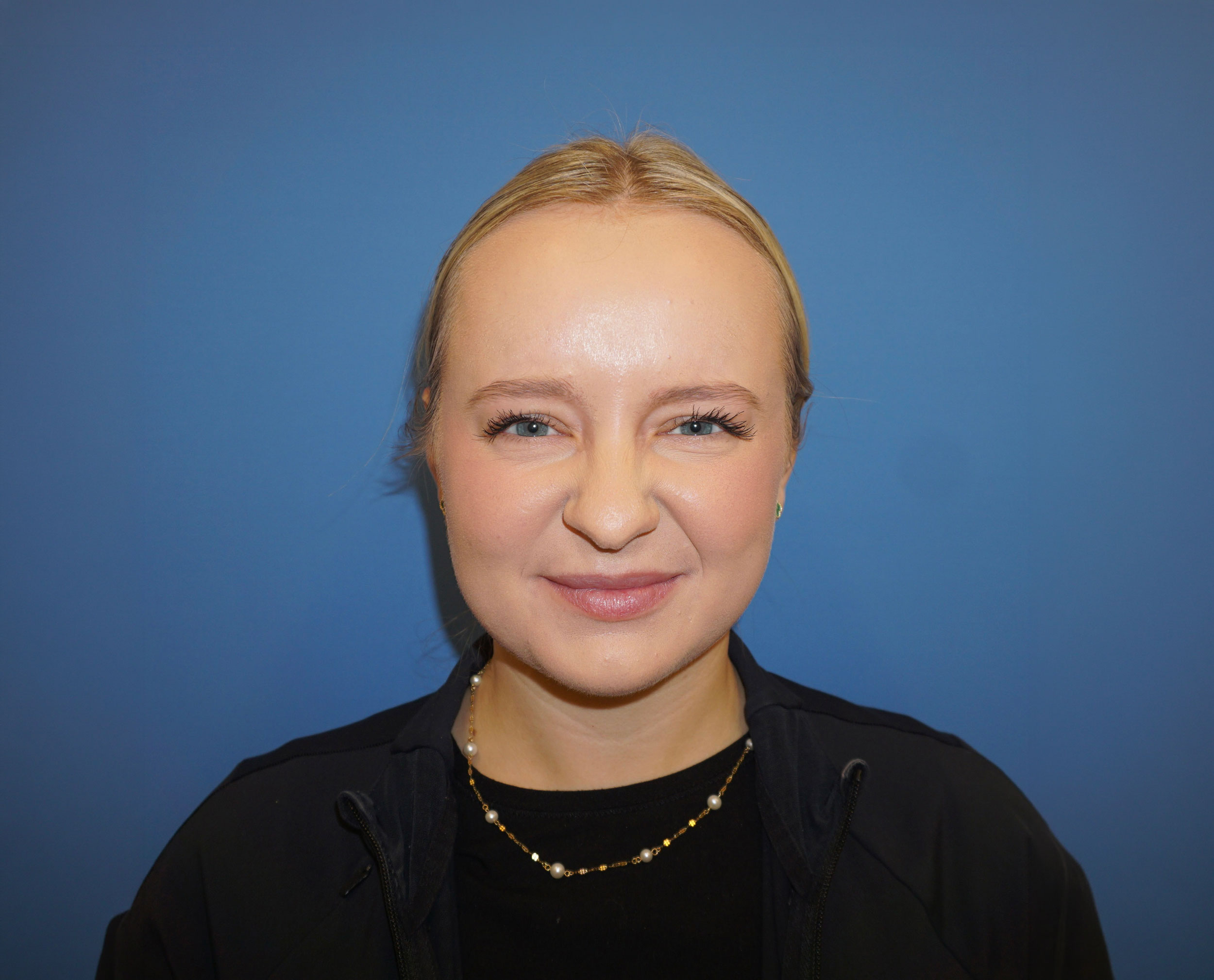 Botox – Patient 16 After