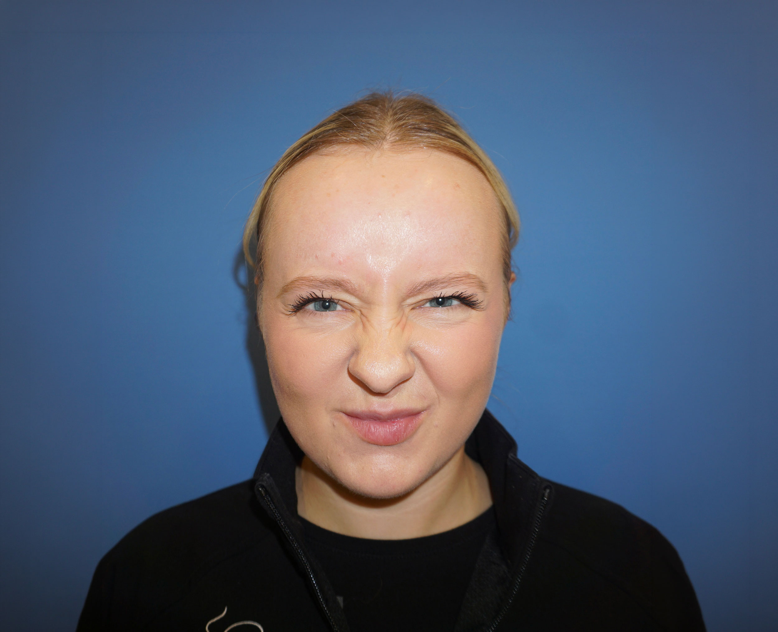 Botox – Patient 16 Before