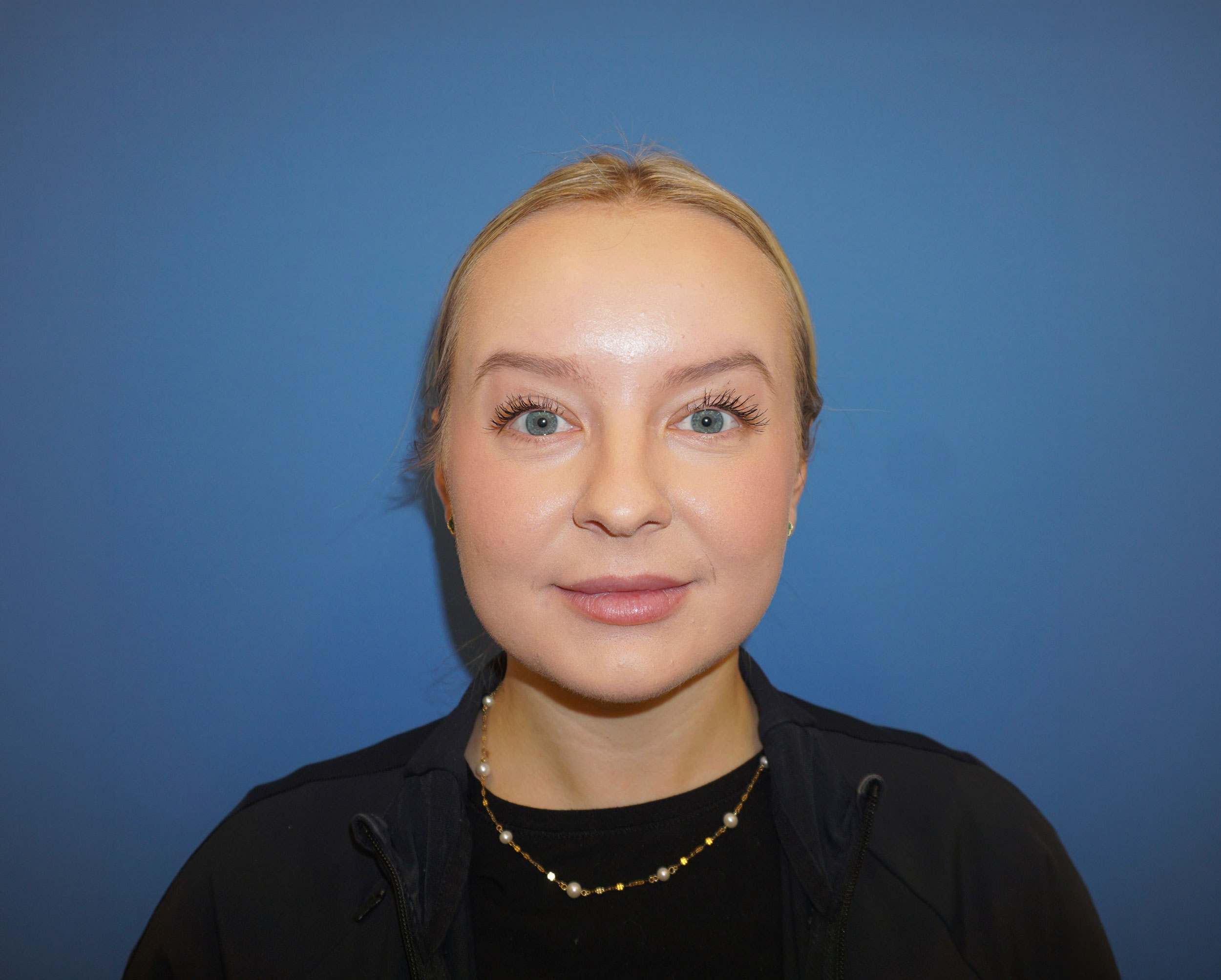 Botox – Patient 17 After