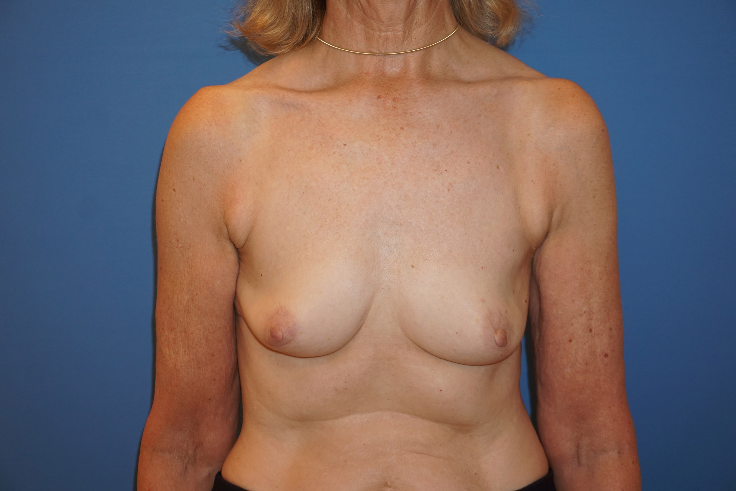 Breast Reconstruction for Cancer – Patient 17 Before