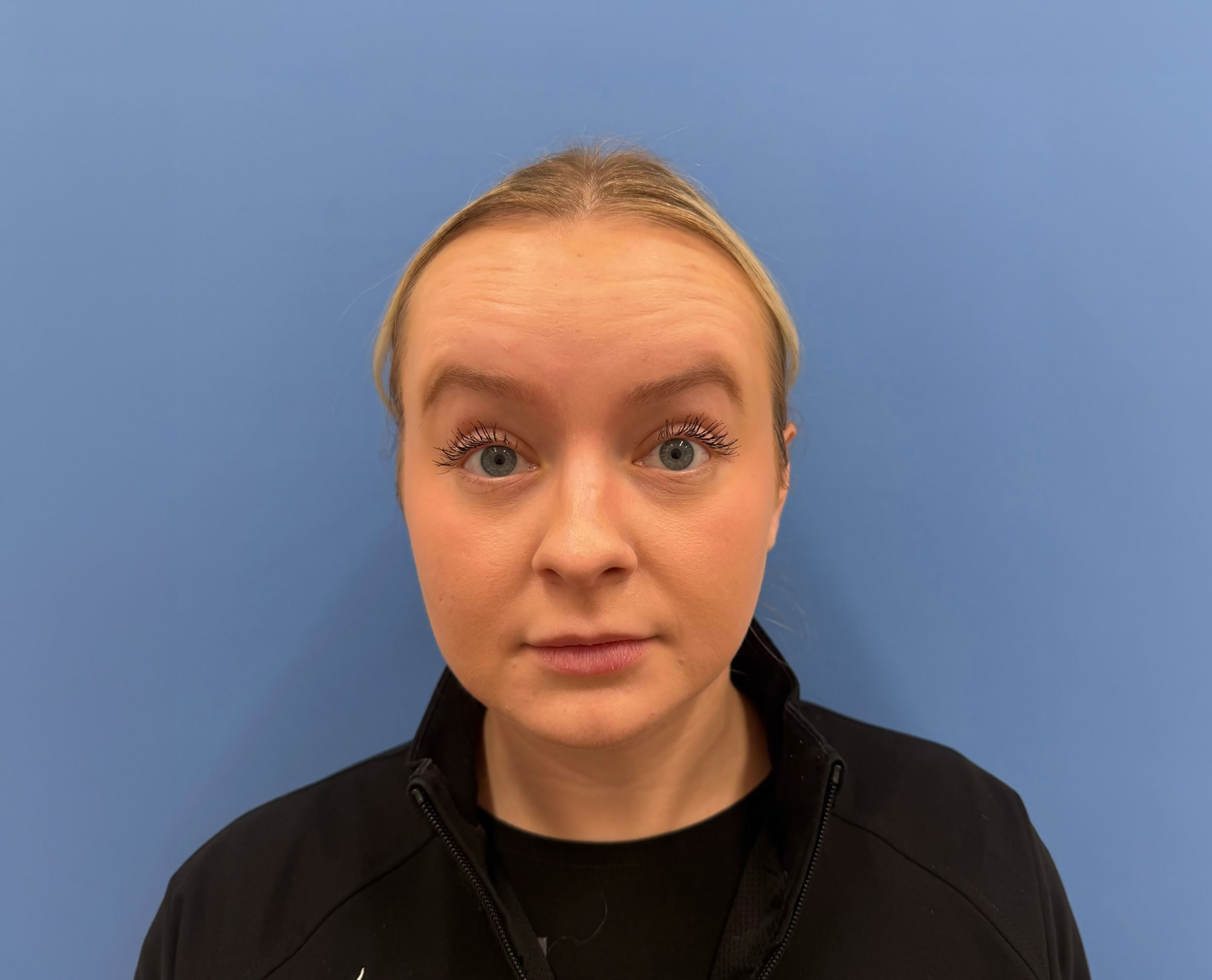 Botox – Patient 17 Before