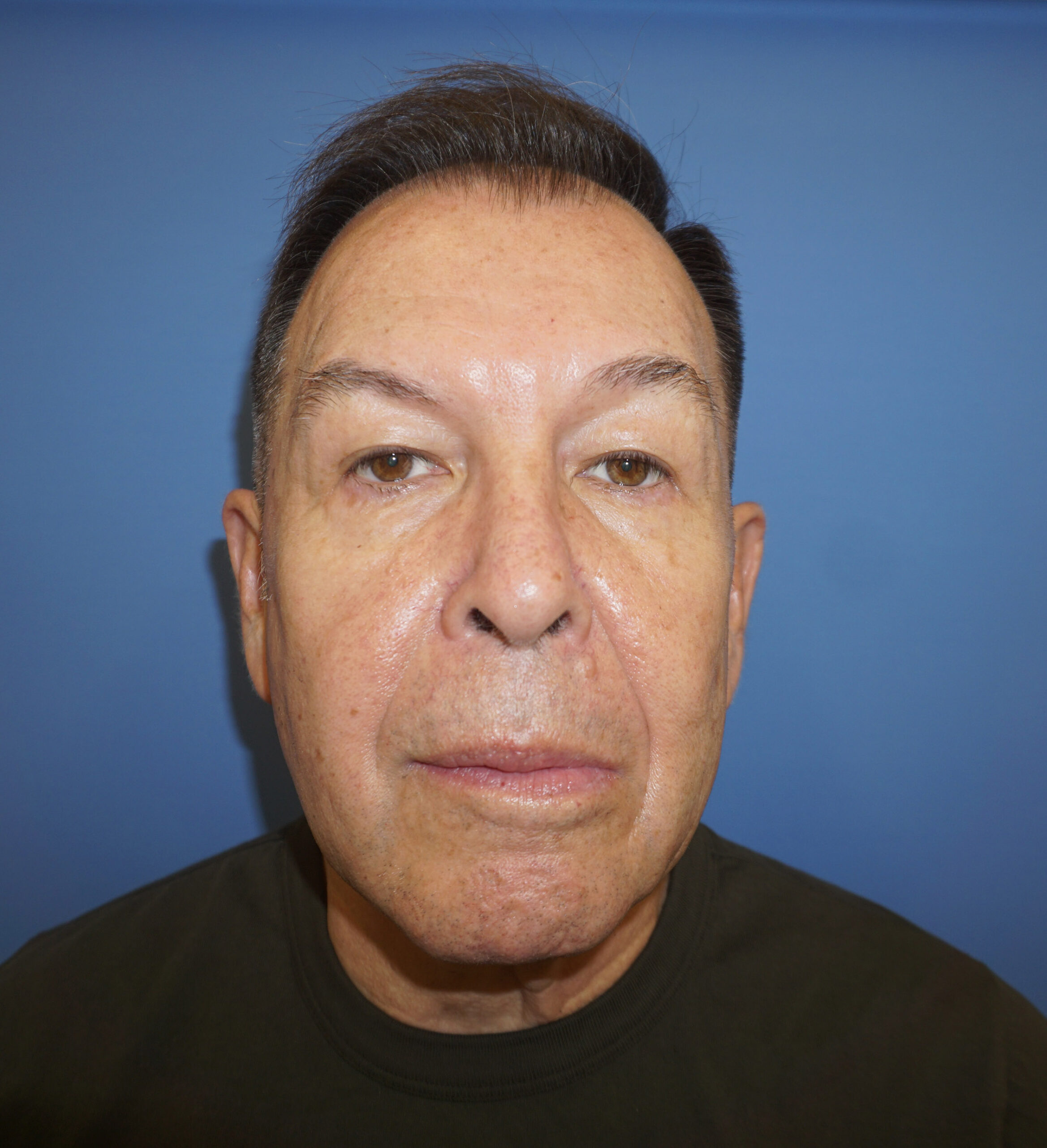 Blepharoplasty – Patient 18 Before