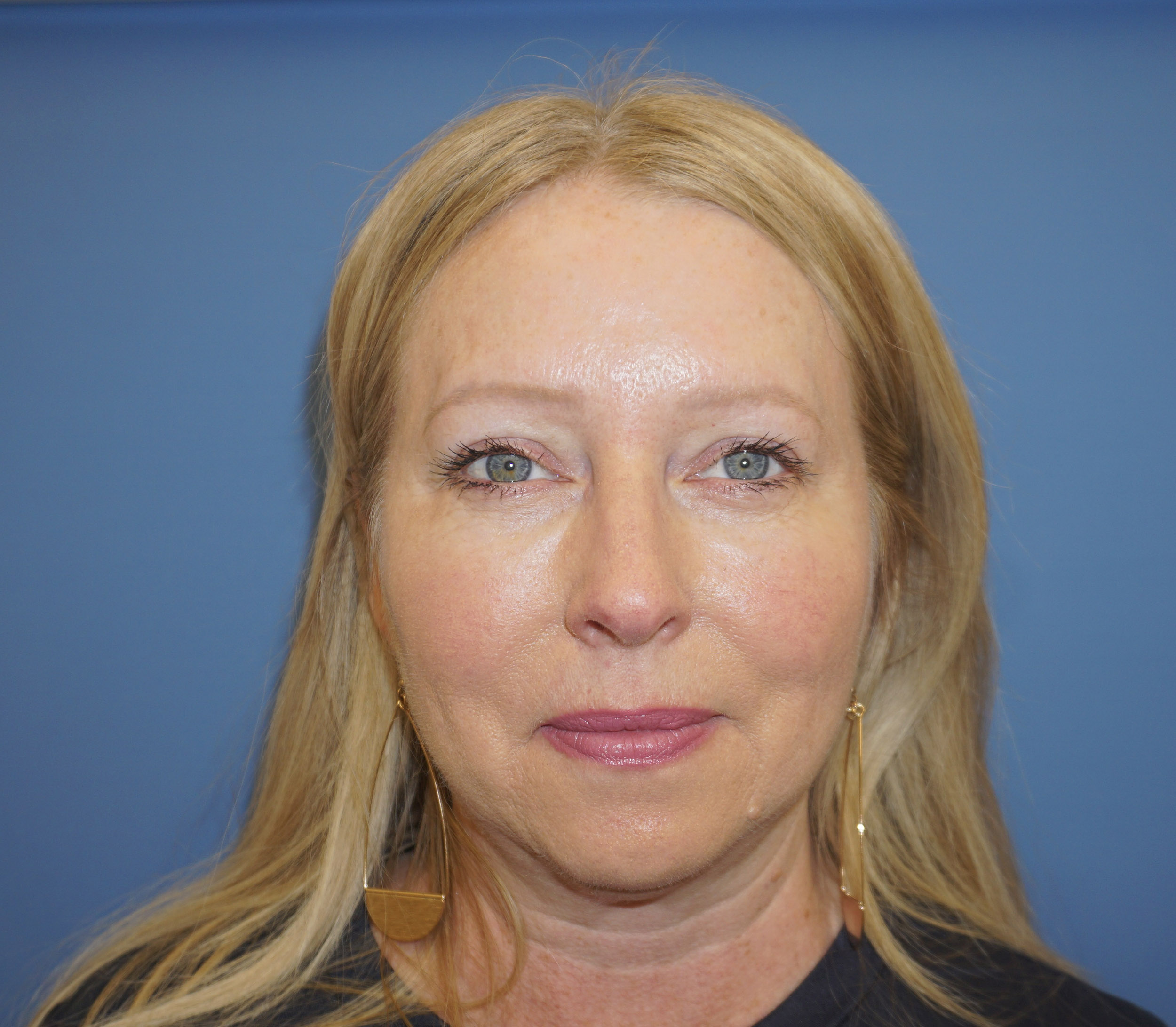Blepharoplasty – Patient 19 Before